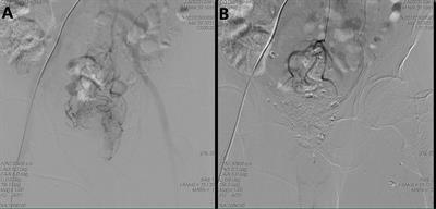 Regional transarterial chemoembolization combined with chemoradiotherapy for locally advanced rectal cancer: a retrospective study of a new combination